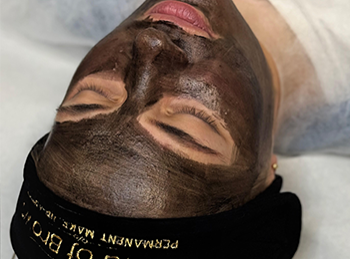 CARBON PEEL LASER